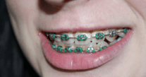 woman with Braces