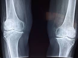 knee x-ray image